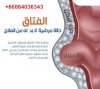 علاج الفتاق في تايلاند
