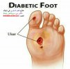 Diabetic foot treatment in Thailand.jpeg