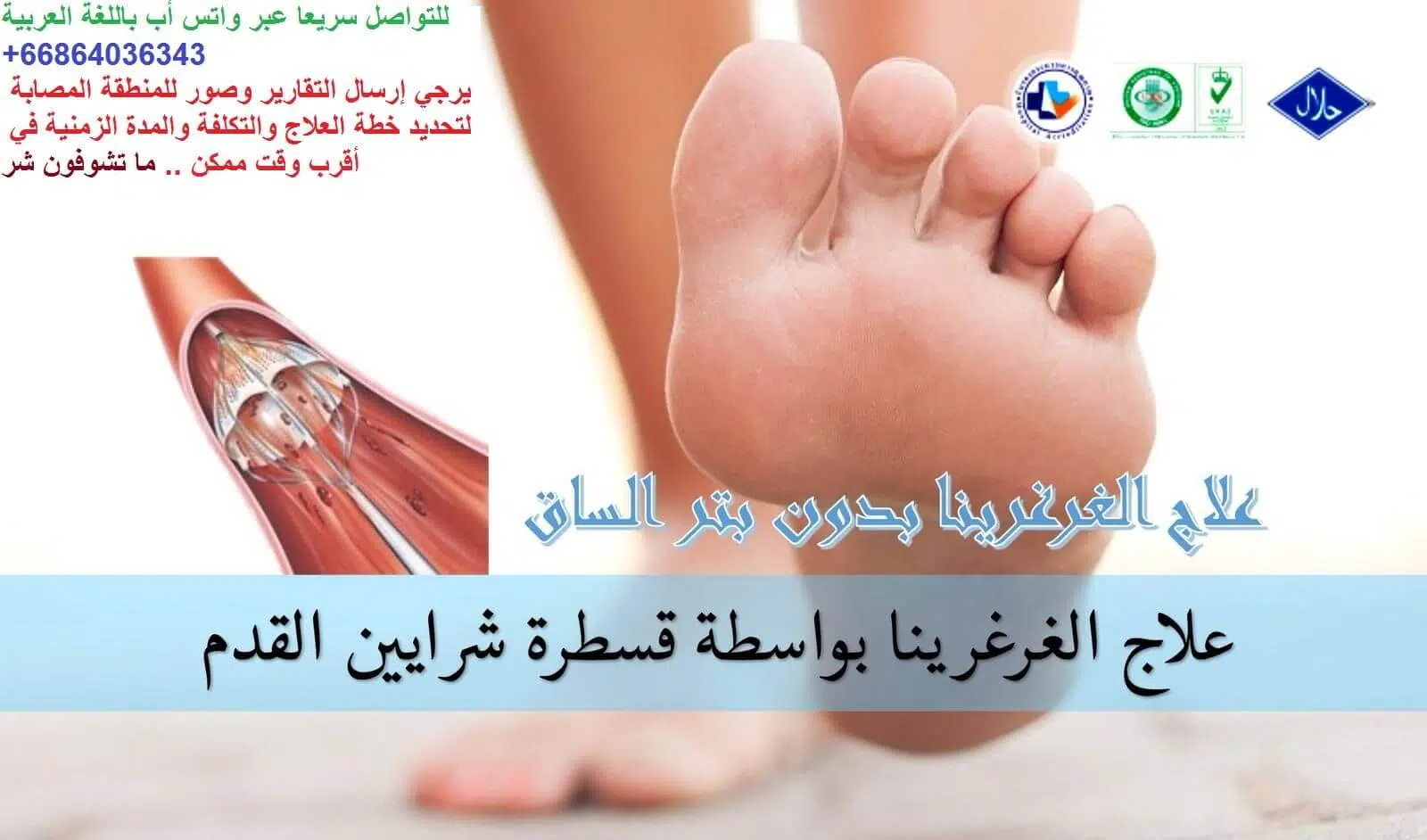 هل يوجد علاج للغرغرينا غير البتر ؟ 
