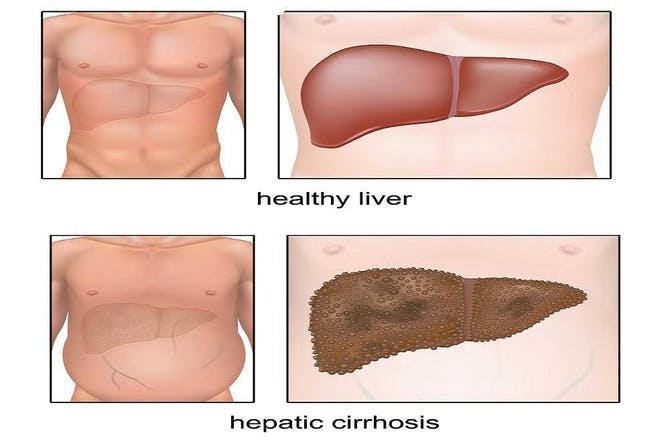 Liver cirrhosis treatment in Thailand