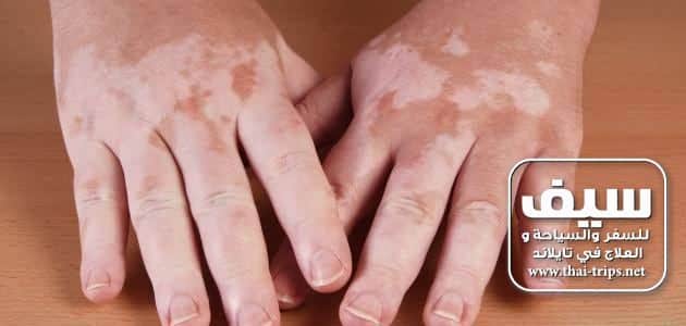 Vitiligo treatment in Thailand