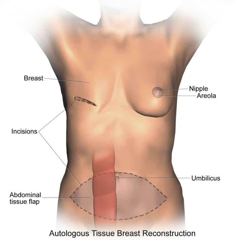 ترميم الثدي بعد جراحة الثدي (إعادة بناء الثدي) تايلاند 2024 